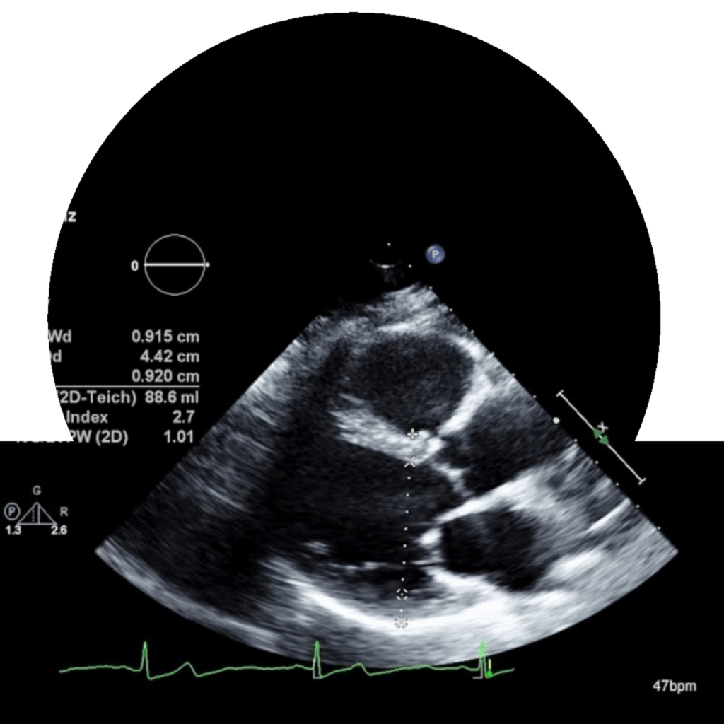 2d echocardiogram