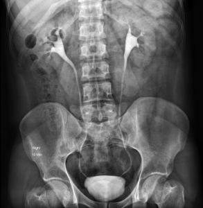 IVP Test Overview And Why Is An Intravenous Pyelogram Performed - Deep ...