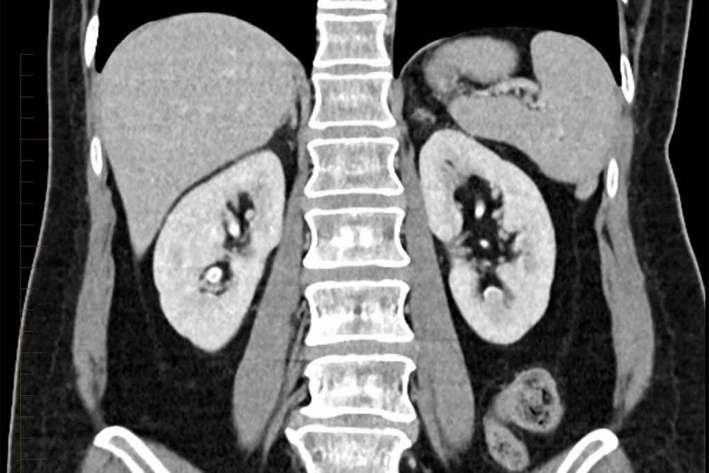 2) CT scan kidneys: Types Of CT Scans