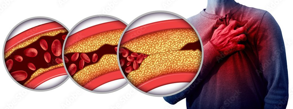 Cholesterol